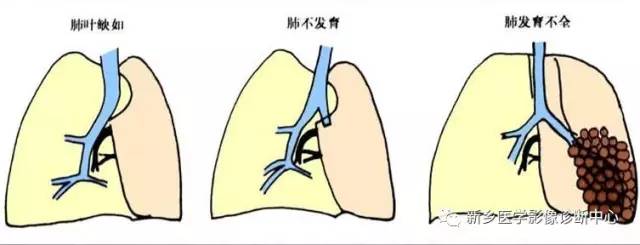 12种肺部发育异常，您知道几种？