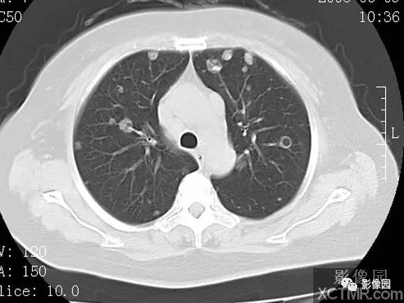 【病例】子宫内膜癌双肺转移1例CT