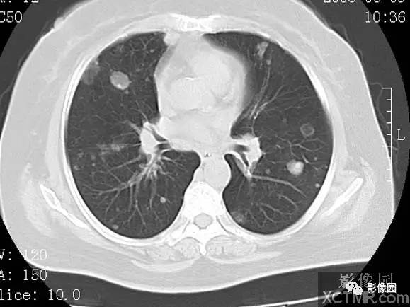 【病例】子宫内膜癌双肺转移1例CT