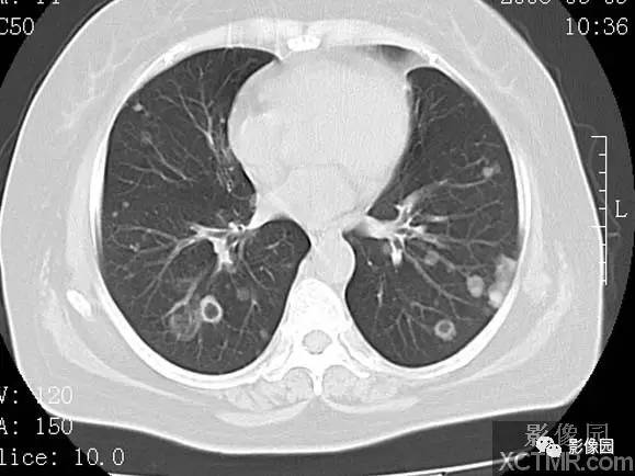 【病例】子宫内膜癌双肺转移1例CT