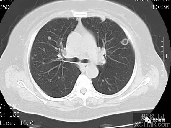 【病例】子宫内膜癌双肺转移1例CT
