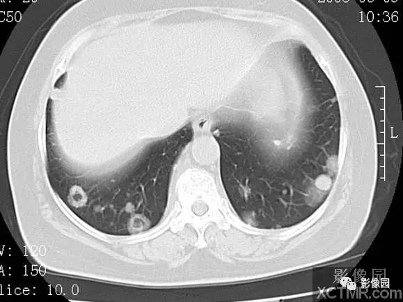 【病例】子宫内膜癌双肺转移1例CT