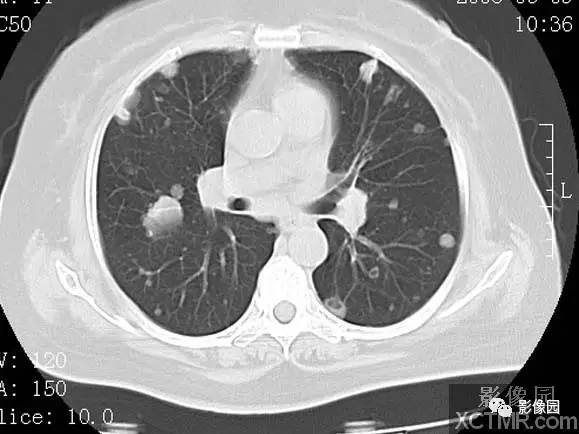 【病例】子宫内膜癌双肺转移1例CT