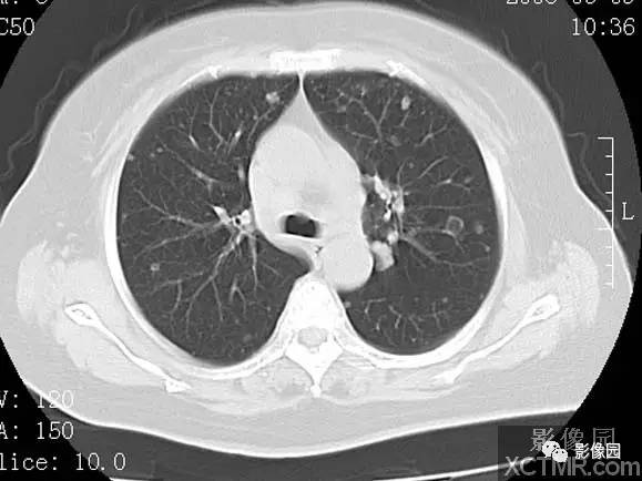 【病例】子宫内膜癌双肺转移1例CT