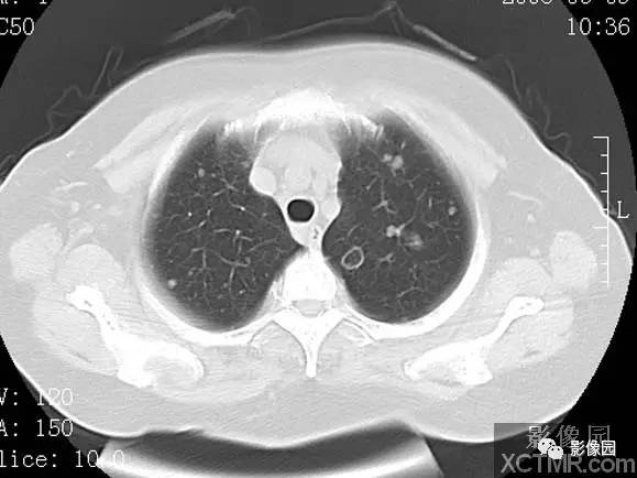 【病例】子宫内膜癌双肺转移1例CT