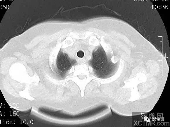 【病例】子宫内膜癌双肺转移1例CT