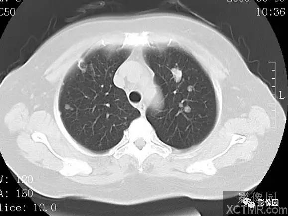 【病例】子宫内膜癌双肺转移1例CT