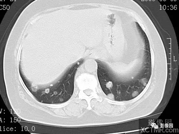 【病例】子宫内膜癌双肺转移1例CT