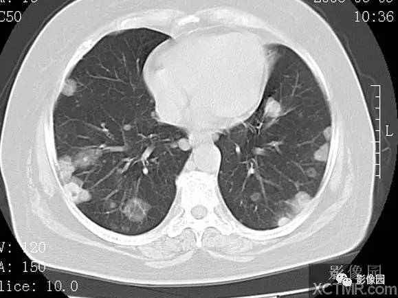 【病例】子宫内膜癌双肺转移1例CT