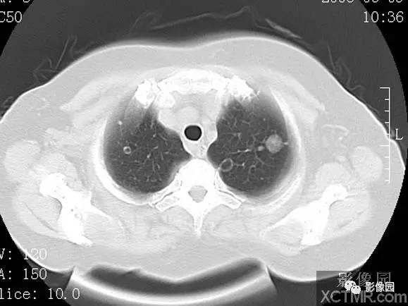【病例】子宫内膜癌双肺转移1例CT