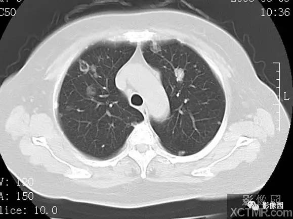 【病例】子宫内膜癌双肺转移1例CT