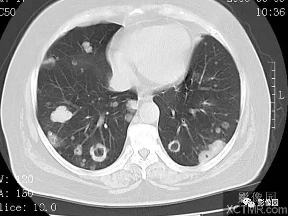 【病例】子宫内膜癌双肺转移1例CT