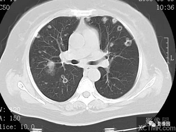 【病例】子宫内膜癌双肺转移1例CT
