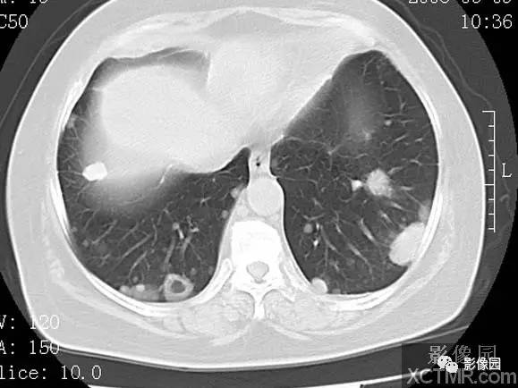 【病例】子宫内膜癌双肺转移1例CT