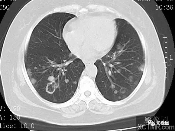 【病例】子宫内膜癌双肺转移1例CT