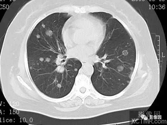 【病例】子宫内膜癌双肺转移1例CT