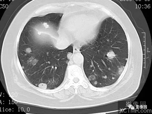 【病例】子宫内膜癌双肺转移1例CT