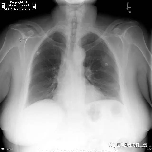 【病例】类风湿性关节炎继发心包积液1例X线CT
