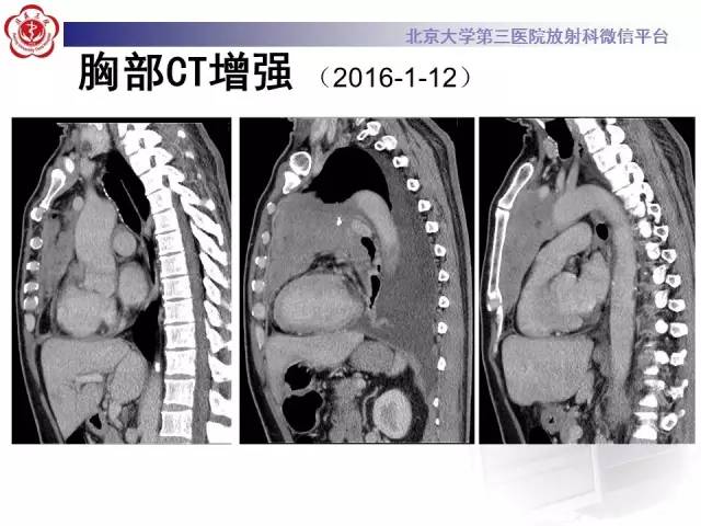 【病例】白血病肺部纵隔浸润1例CT影像表现