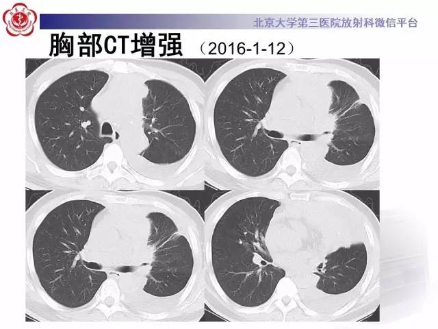 【病例】白血病肺部纵隔浸润1例CT影像表现