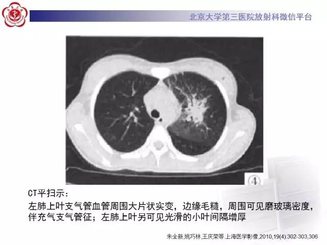 【病例】白血病肺部纵隔浸润1例CT影像表现