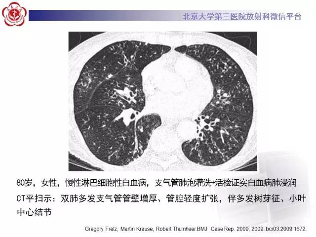 【病例】白血病肺部纵隔浸润1例CT影像表现
