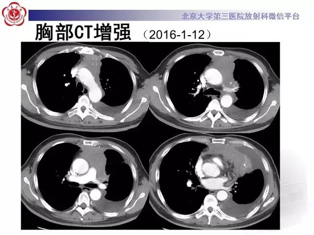 【病例】白血病肺部纵隔浸润1例CT影像表现