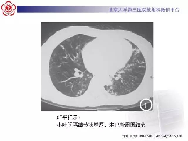【病例】白血病肺部纵隔浸润1例CT影像表现