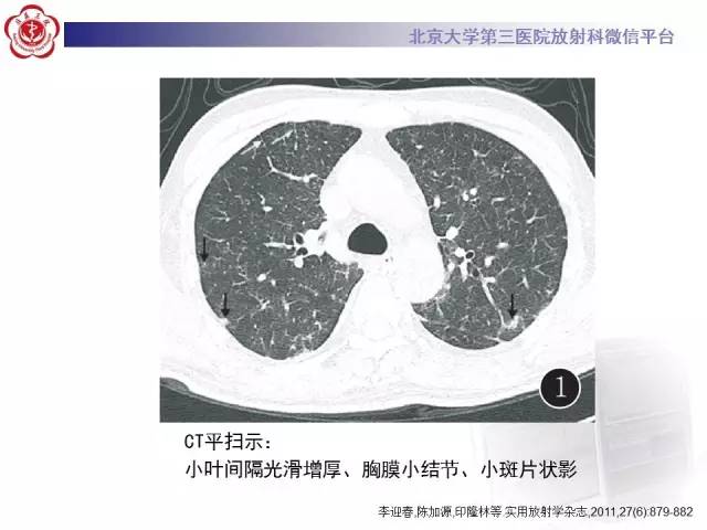 【病例】白血病肺部纵隔浸润1例CT影像表现