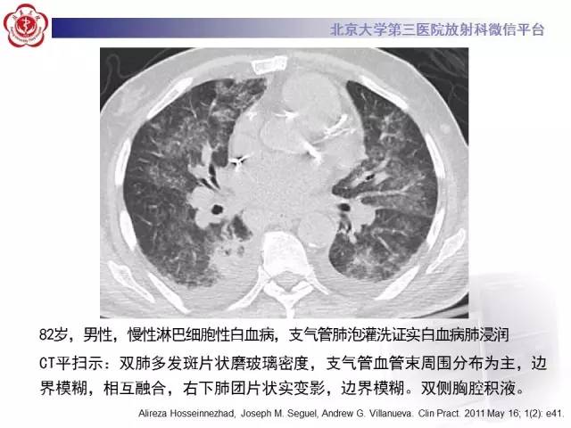 【病例】白血病肺部纵隔浸润1例CT影像表现
