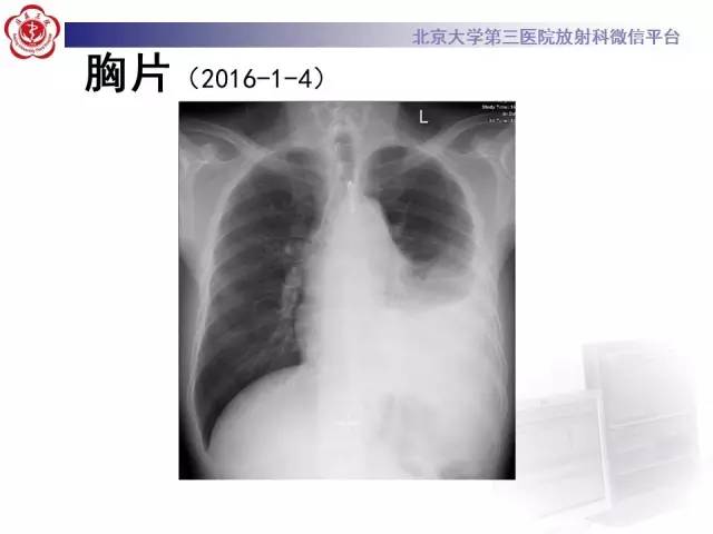【病例】白血病肺部纵隔浸润1例CT影像表现