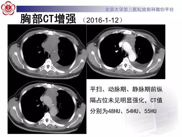【病例】白血病肺部纵隔浸润1例CT影像表现