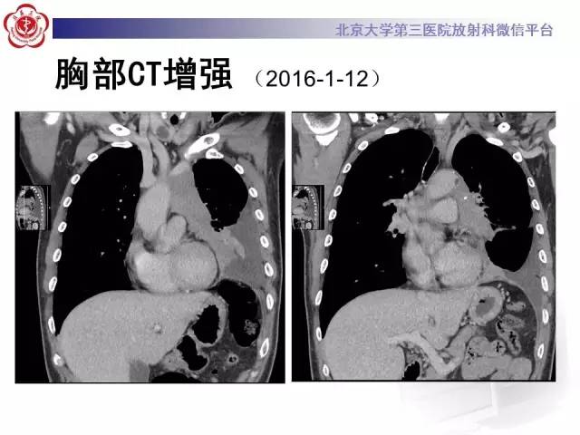【病例】白血病肺部纵隔浸润1例CT影像表现