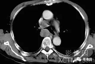 【病例】右肺下叶背段周围性肺癌1例CT