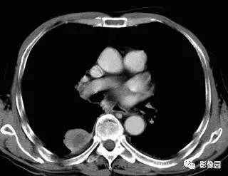 【病例】右肺下叶背段周围性肺癌1例CT