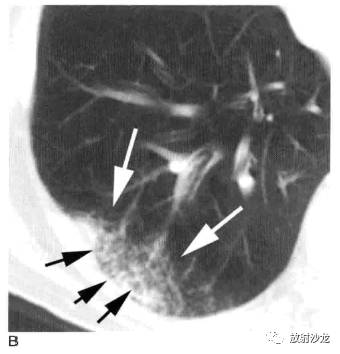 肺实变的影像学表现