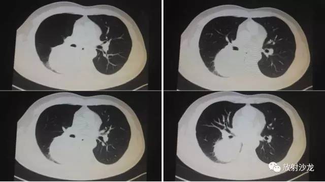 【病例】肺硬化性血管瘤1例CT影像讨论