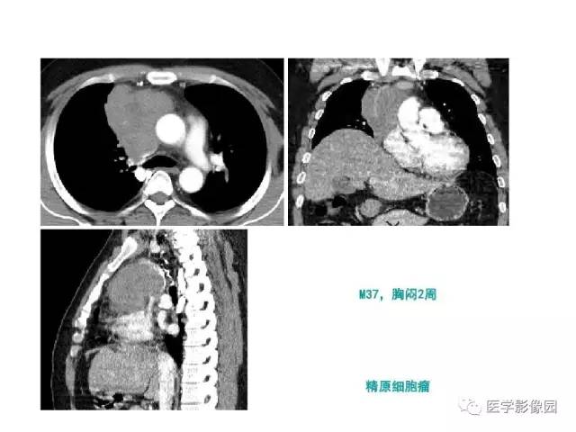 【病例】纵隔胸腺神经内分泌癌1例CT影像分析