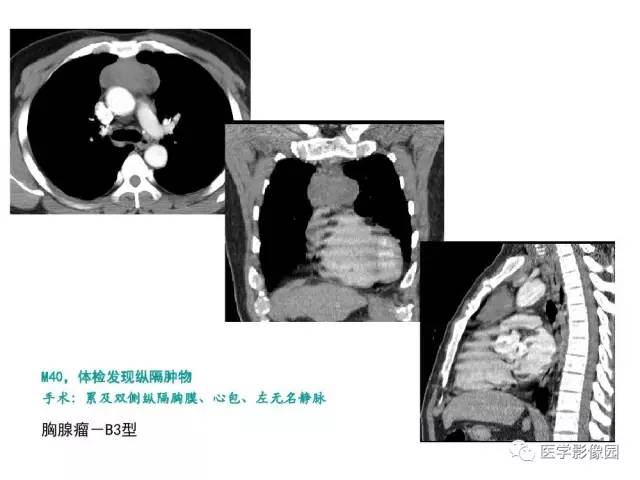 【病例】纵隔胸腺神经内分泌癌1例CT影像分析