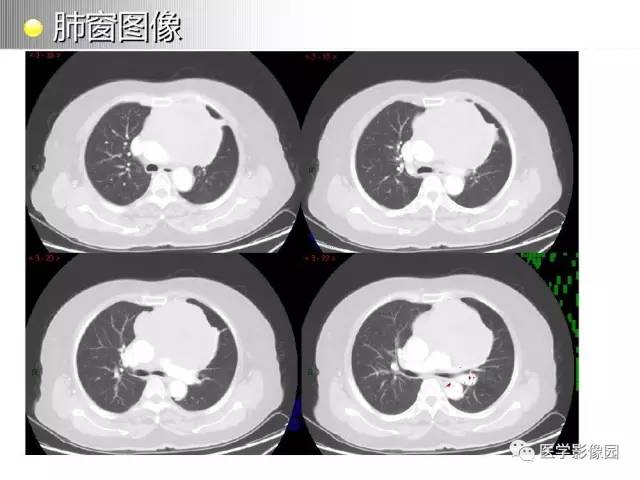【病例】纵隔胸腺神经内分泌癌1例CT影像分析