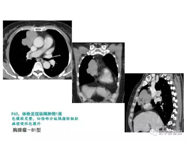 【病例】纵隔胸腺神经内分泌癌1例CT影像分析