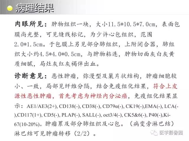 【病例】纵隔胸腺神经内分泌癌1例CT影像分析