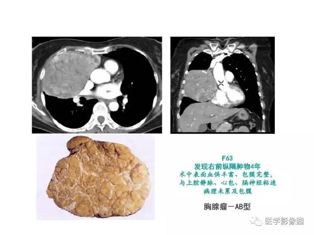 【病例】纵隔胸腺神经内分泌癌1例CT影像分析