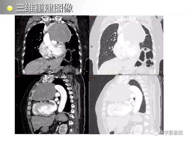 【病例】纵隔胸腺神经内分泌癌1例CT影像分析
