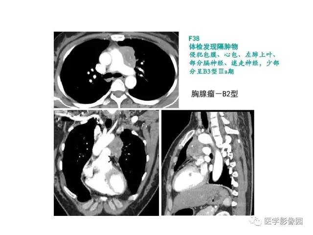 【病例】纵隔胸腺神经内分泌癌1例CT影像分析
