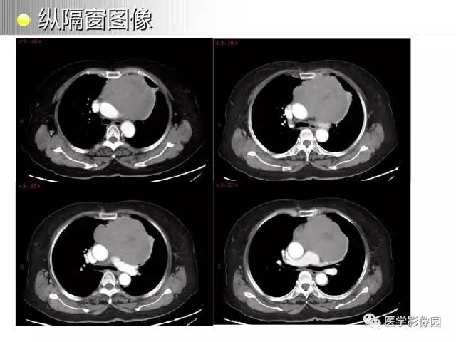 【病例】纵隔胸腺神经内分泌癌1例CT影像分析
