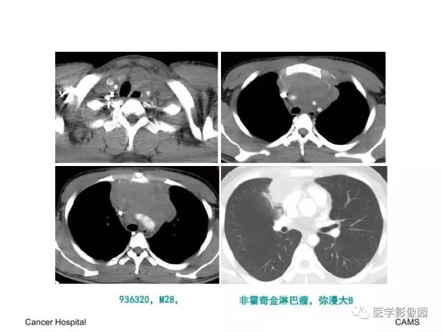 【病例】纵隔胸腺神经内分泌癌1例CT影像分析