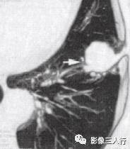 “血管切迹征” 的影像表现与临床意义