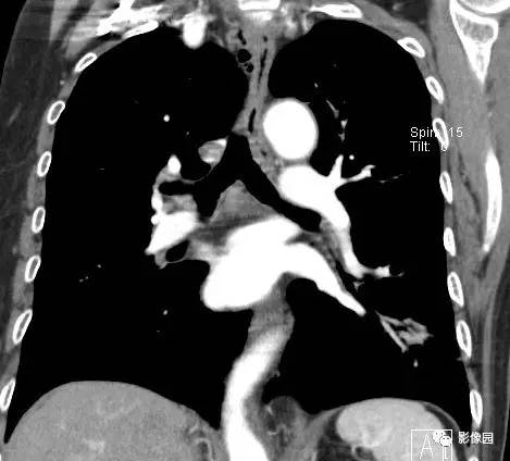 【病例】左下肺鳞癌1例CT
