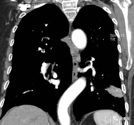 【病例】左下肺鳞癌1例CT